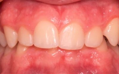 Tiefbiss-Deepbite-768x355